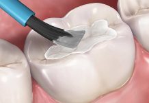 Герметизация фиссур: суть процедуры и ее преимущества