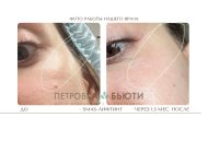 Смас лифтинг на аппарате Ультраформер MPT