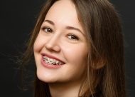 Для чего ставятся металлические брекеты?