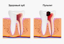 Пульпит: что это такое, лечение