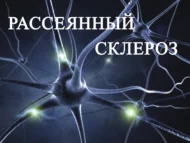 Можно ли вылечить рассеянный склероз: современные подходы и возможности
