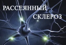 Можно ли вылечить рассеянный склероз: современные подходы и возможности