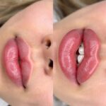 Увеличение губ: эстетическое совершенствование внешности