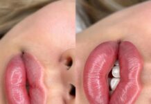 Увеличение губ: эстетическое совершенствование внешности